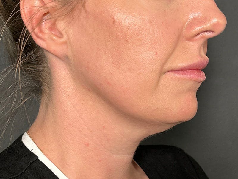 Submental Before & After Gallery - Patient 281129 - Image 3