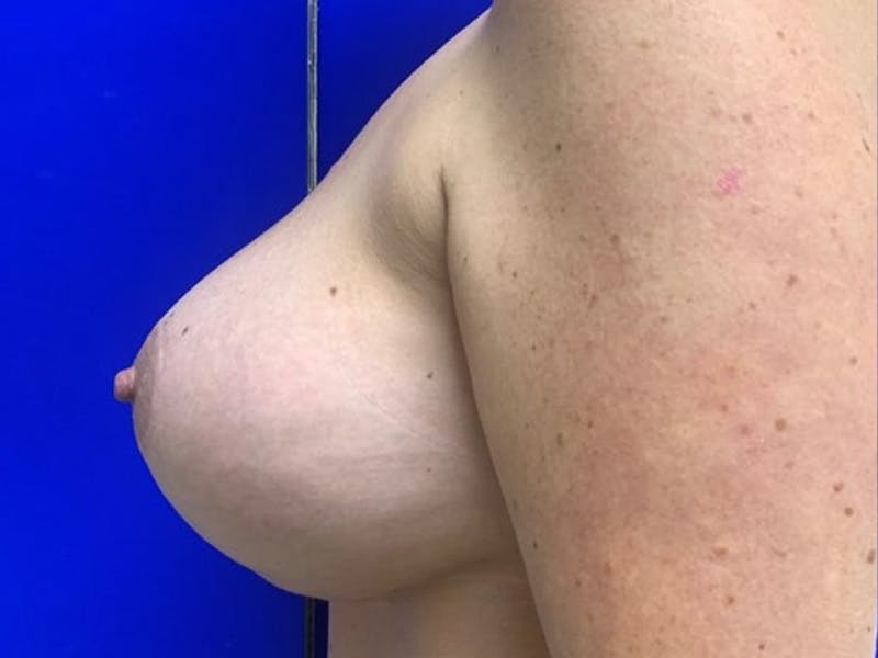 Breast Augmentation with Lift Before & After Gallery - Patient 114025 - Image 6