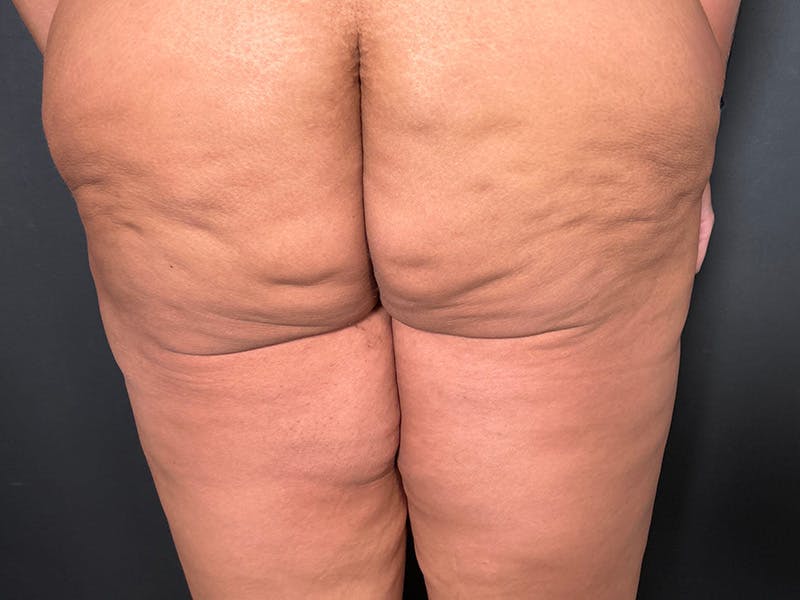 Thigh Lift Before & After Gallery - Patient 128992 - Image 7