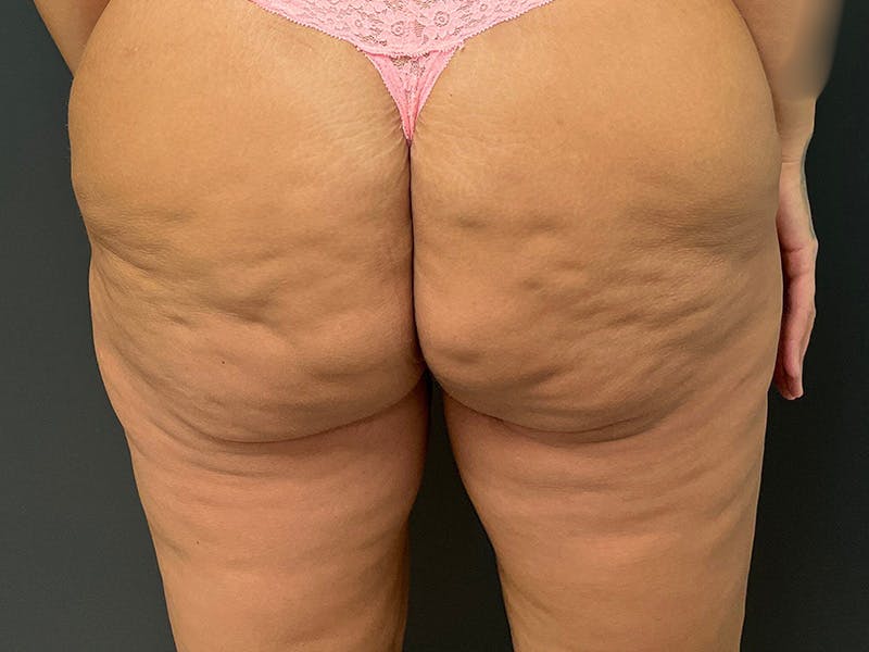 Thigh Lift Before & After Gallery - Patient 128992 - Image 8