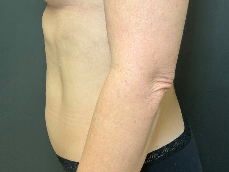 Abdomen Before & After Gallery - Patient 151954 - Image 10
