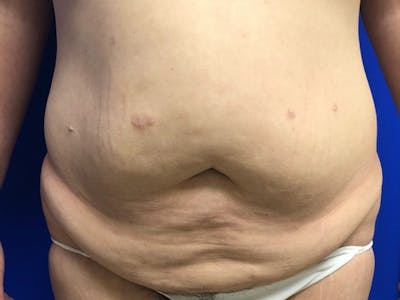 Tummy Tuck Before & After Gallery - Patient 308747 - Image 1