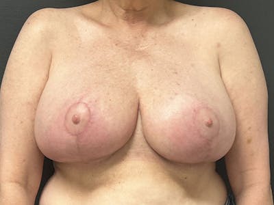 Breast Reduction Before & After Gallery - Patient 275306 - Image 2
