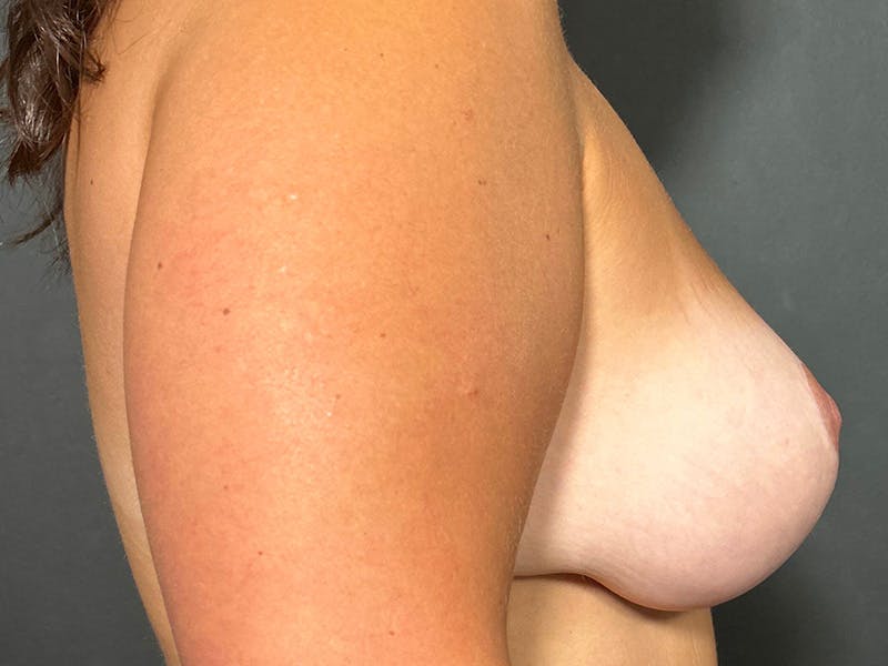 Mastopexy (Breast Lift) Before & After Gallery - Patient 279579 - Image 8