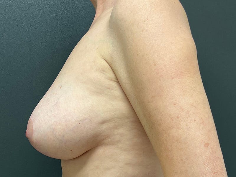 Mastopexy (Breast Lift) Before & After Gallery - Patient 402414 - Image 10