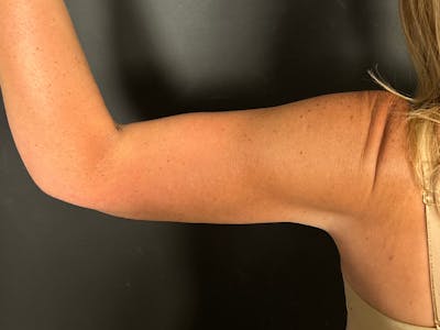 Arm Lift Before & After Gallery - Patient 298268 - Image 2
