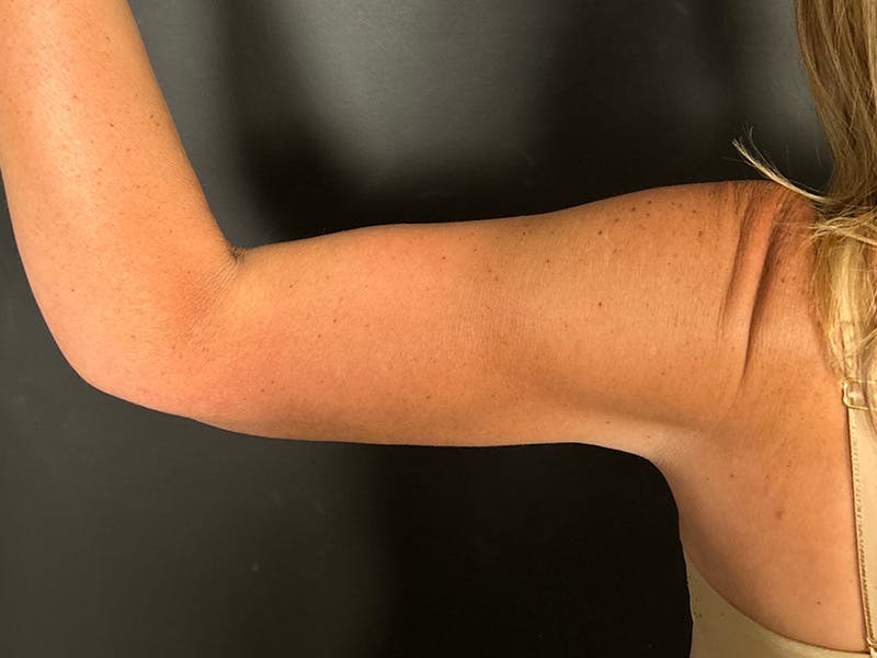 Arm Lift Before & After Gallery - Patient 298268 - Image 2