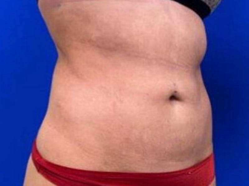 Tummy Tuck Before & After Gallery - Patient 266737 - Image 4