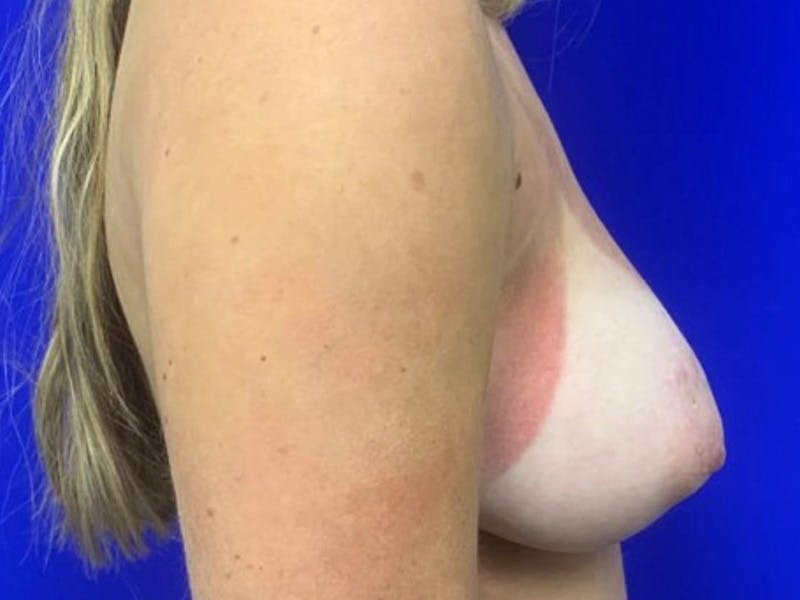 Breast Reduction Before & After Gallery - Patient 117382 - Image 5
