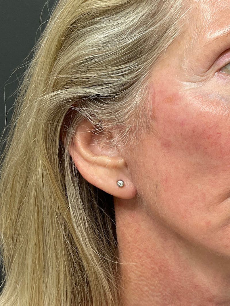 Earlobe Repair Before & After Gallery - Patient 298992 - Image 4