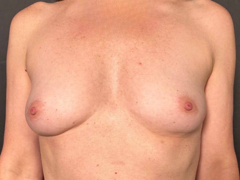 Breast Fat Grafting Before & After Gallery - Patient 902109 - Image 1