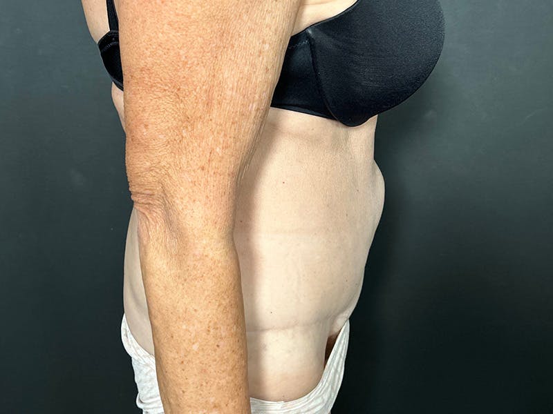 Tummy Tuck Before & After Gallery - Patient 394420 - Image 5