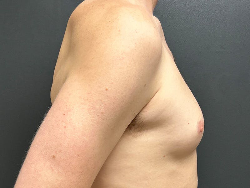 Gynecomastia Before & After Gallery - Patient 376405 - Image 5