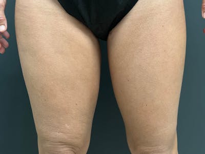 Thigh Lift Before & After Gallery - Patient 105155 - Image 2