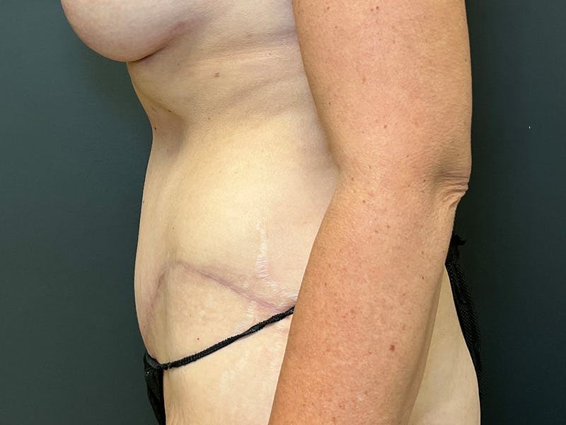 Tummy Tuck Before & After Gallery - Patient 215602 - Image 10