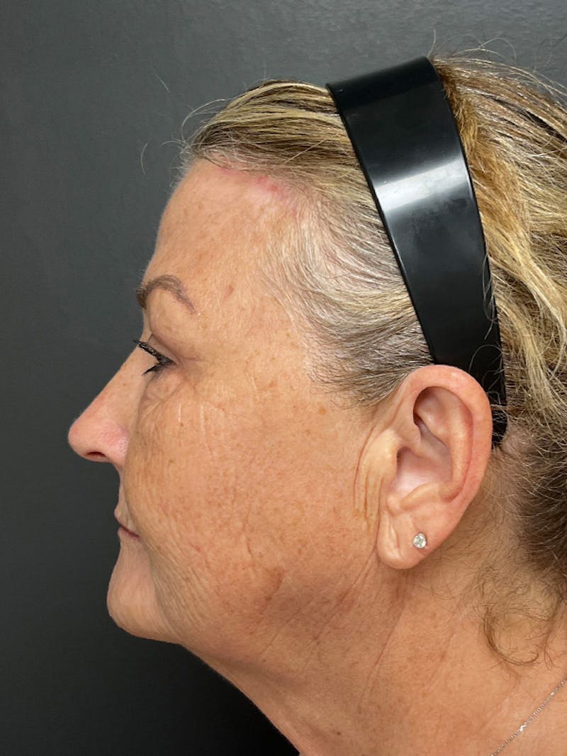 Brow Lift Before & After Gallery - Patient 206709 - Image 10