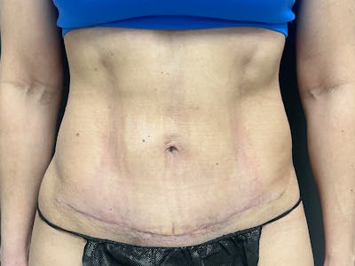 Mini Tummy Tuck Before & After Gallery - Patient 120272 - Image 2