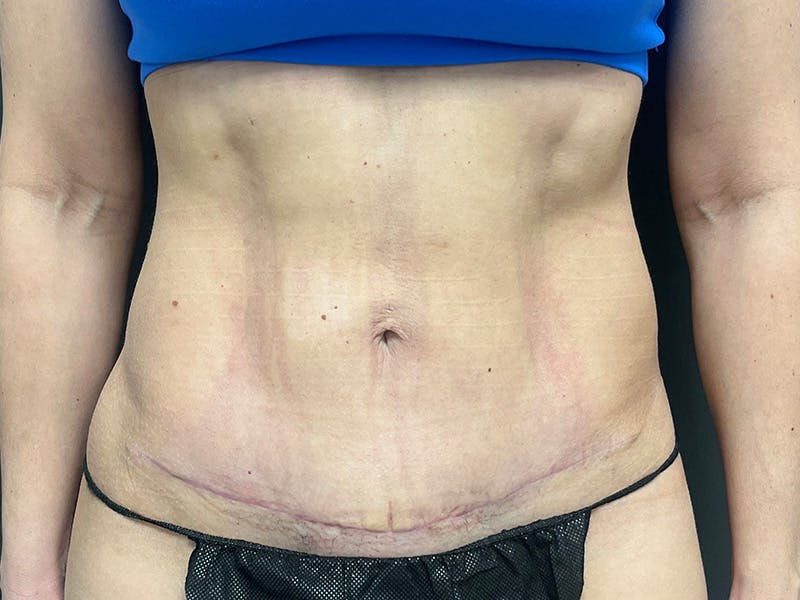 Mini Tummy Tuck Before & After Gallery - Patient 120272 - Image 2