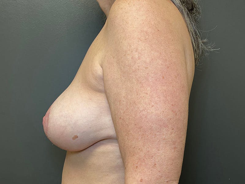 Breast Augmentation with Lift Before & After Gallery - Patient 165974 - Image 10