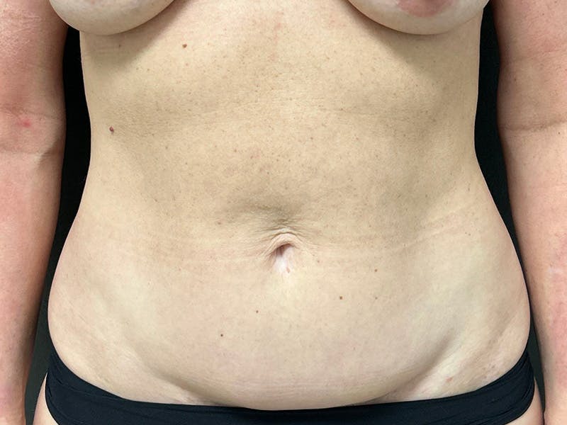 Abdomen Before & After Gallery - Patient 357328 - Image 1