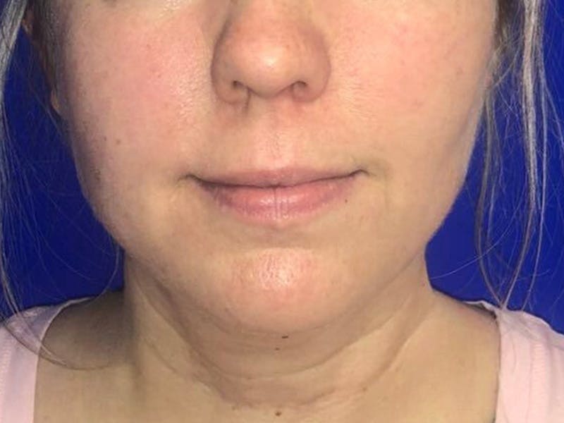 Submental Before & After Gallery - Patient 238853 - Image 4
