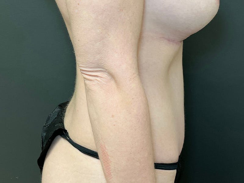 Tummy Tuck Before & After Gallery - Patient 223386 - Image 4