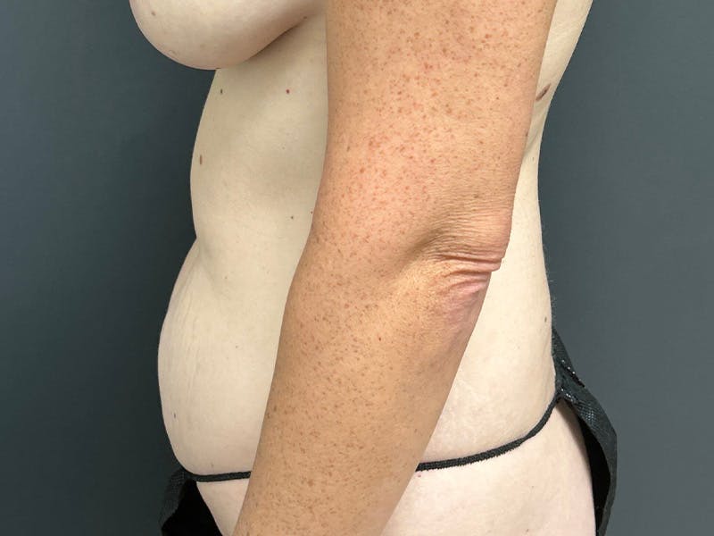 Tummy Tuck Before & After Gallery - Patient 328270 - Image 9