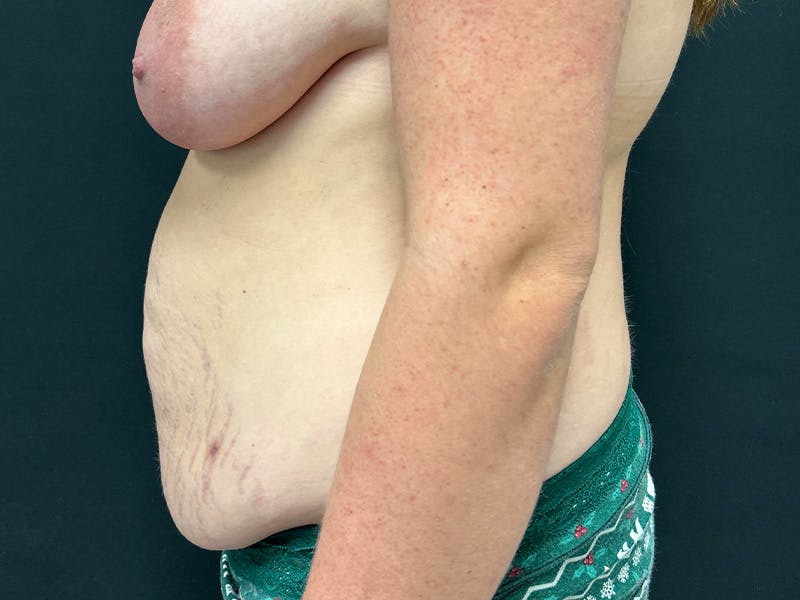 Tummy Tuck Before & After Gallery - Patient 187996 - Image 9