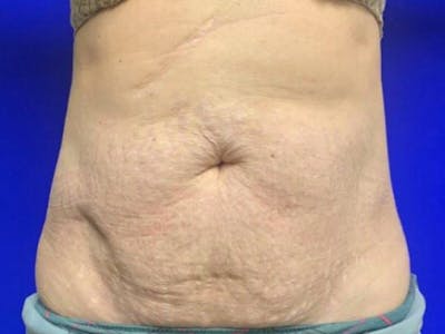 Mini Tummy Tuck Before & After Gallery - Patient 284453 - Image 1