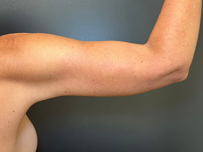 Arm Lift Before & After Gallery - Patient 126876 - Image 4