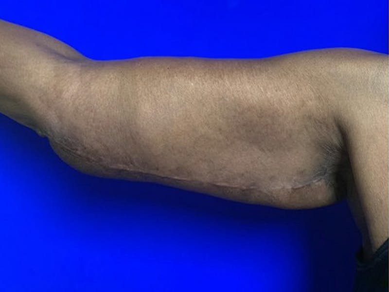 Arm Lift Before & After Gallery - Patient 122659 - Image 6