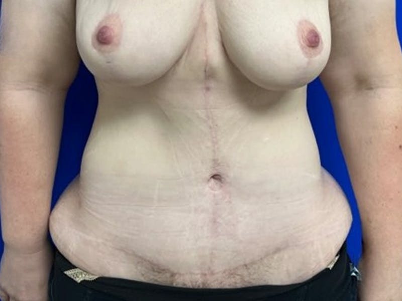Tummy Tuck Before & After Gallery - Patient 115727 - Image 2
