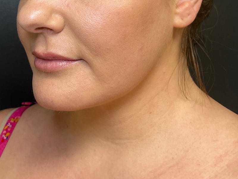 Submental Before & After Gallery - Patient 252708 - Image 8