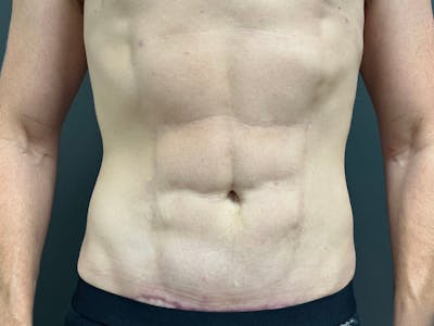Abdomen Before & After Gallery - Patient 406127 - Image 2