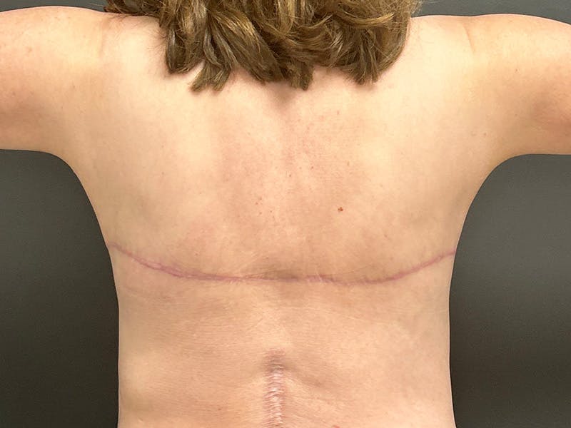 Back Lift Before & After Gallery - Patient 368284 - Image 4