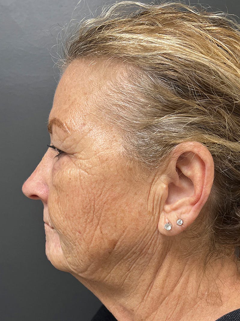 Brow Lift Before & After Gallery - Patient 206709 - Image 9