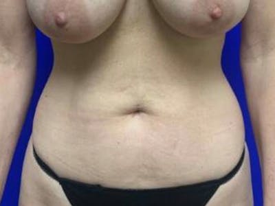 Mini Tummy Tuck Before & After Gallery - Patient 491163 - Image 2
