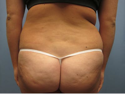 Abdomen Before & After Gallery - Patient 254696 - Image 1