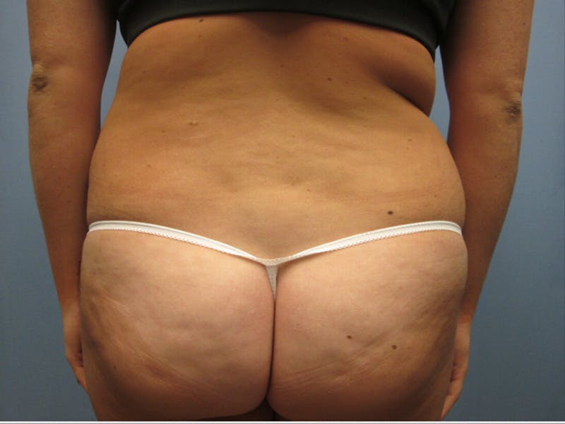 Abdomen Before & After Gallery - Patient 254696 - Image 1