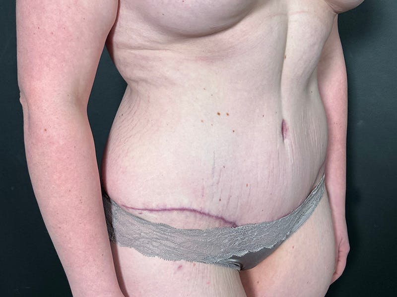 Tummy Tuck Before & After Gallery - Patient 404858 - Image 4