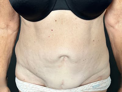 Tummy Tuck Before & After Gallery - Patient 394420 - Image 1