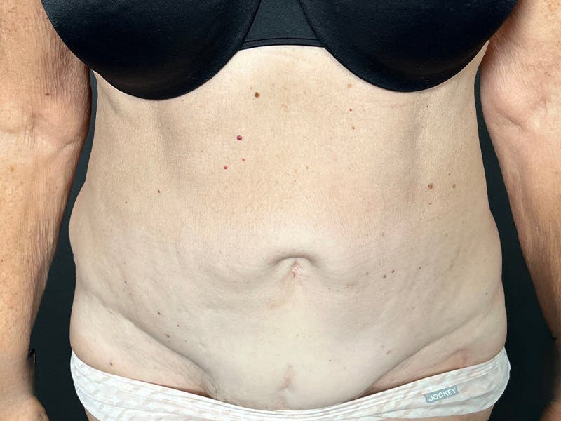 Tummy Tuck Before & After Gallery - Patient 394420 - Image 1