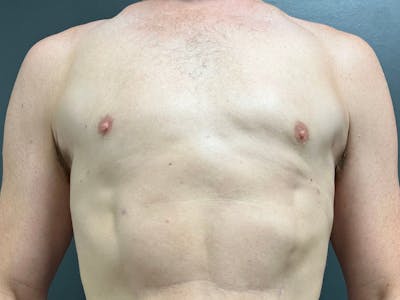 Gynecomastia Before & After Gallery - Patient 376405 - Image 2