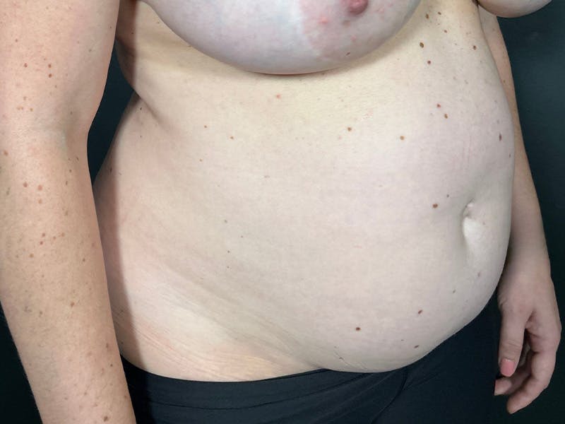 Abdomen Before & After Gallery - Patient 419008 - Image 3