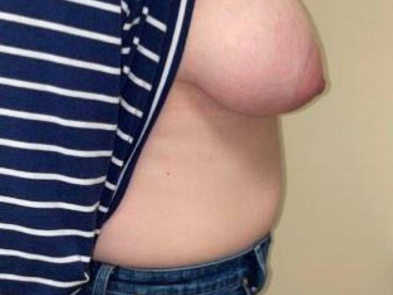 Abdomen Before & After Gallery - Patient 332408 - Image 5