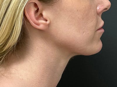Submental Before & After Gallery - Patient 281129 - Image 2