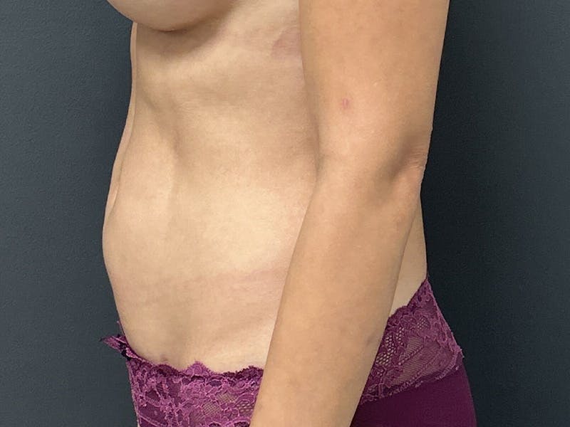 Abdomen Before & After Gallery - Patient 171479 - Image 10