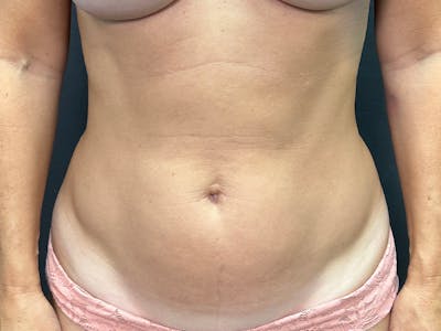Mini Tummy Tuck Before & After Gallery - Patient 246074 - Image 1