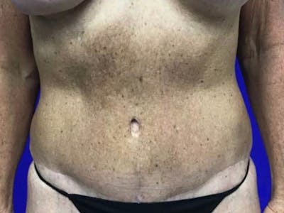 Tummy Tuck Before & After Gallery - Patient 334681 - Image 2