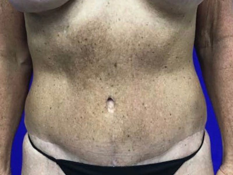 Tummy Tuck Before & After Gallery - Patient 334681 - Image 2
